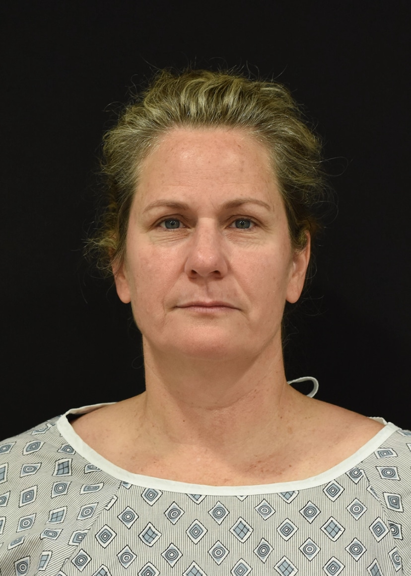 Extended Deep Plane Facelift Patient 11 Set 1 Before