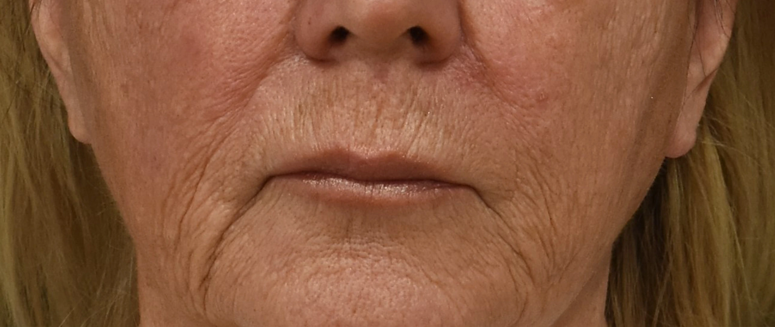 Lip Lift Patient 1 Set 1 Before